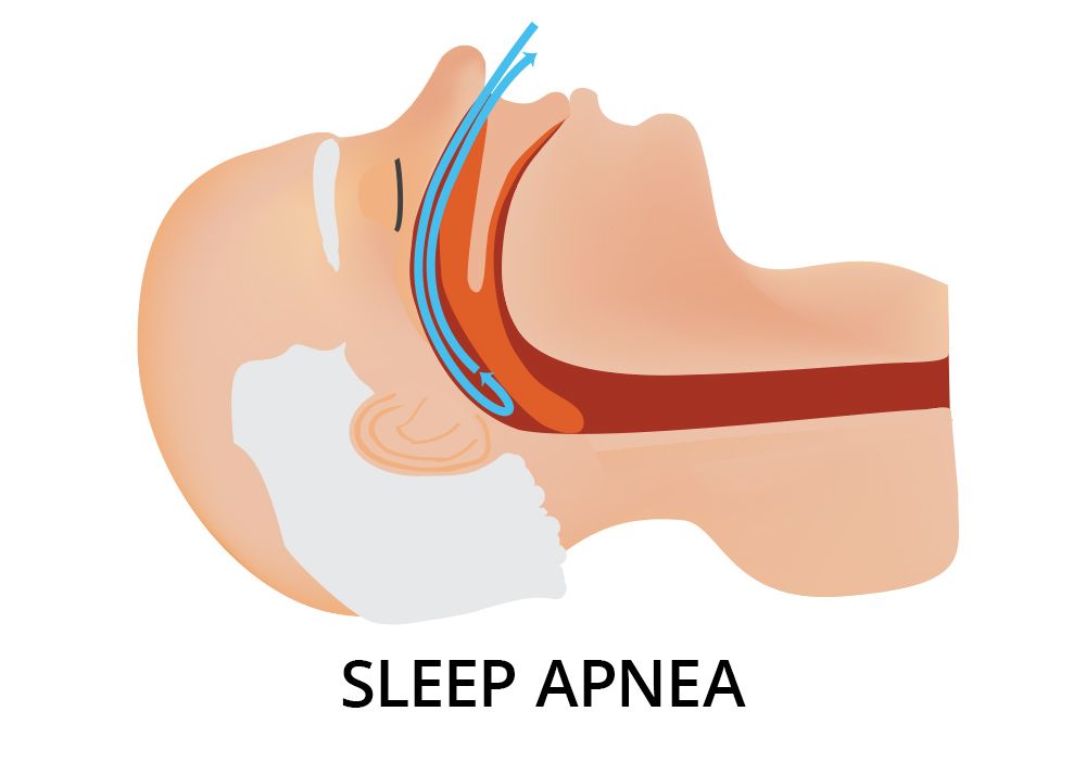 Illustration showing the effects of sleep apnea