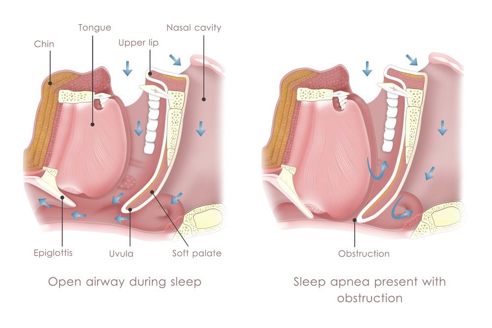 Illustration showing the effects of sleep apnea