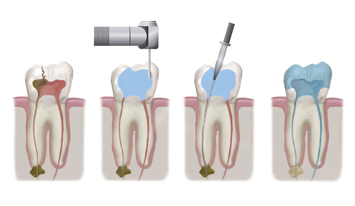 Illustration showing the stages of endodontic surgery