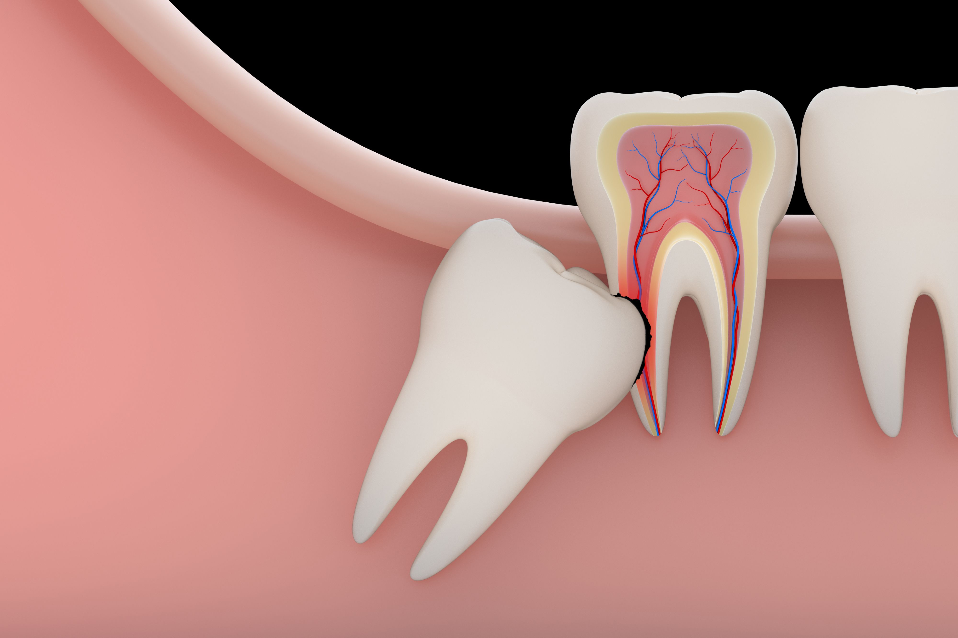 Illustration of a wisdom tooth growing into adjacent tooth