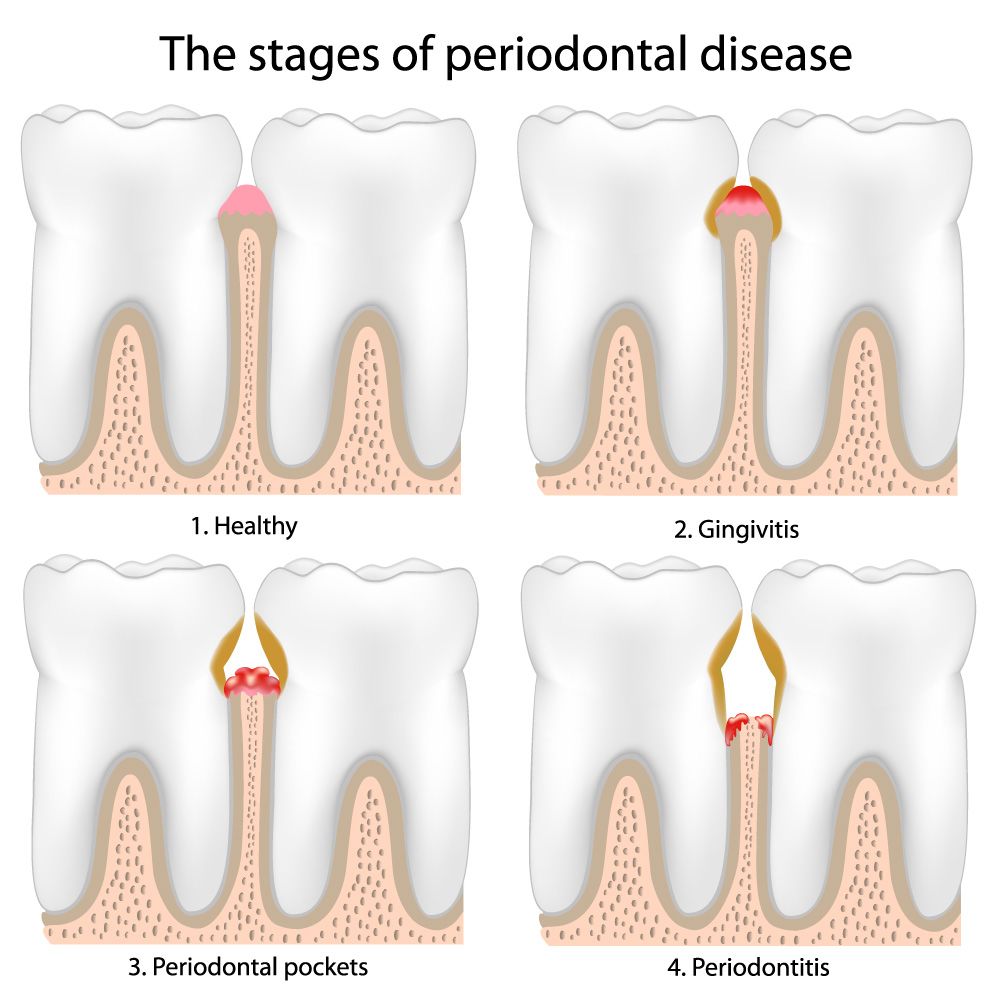 Illustration showing the stages of periodontal disease