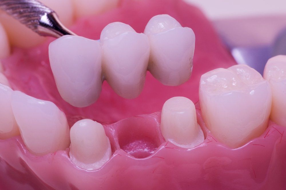 A dental bridge being removed from a row of fake teeth