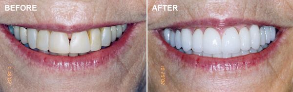 Before and after images of a smile makeover patient.