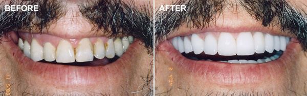Before and after smile makeover shots of a man with a mustache
