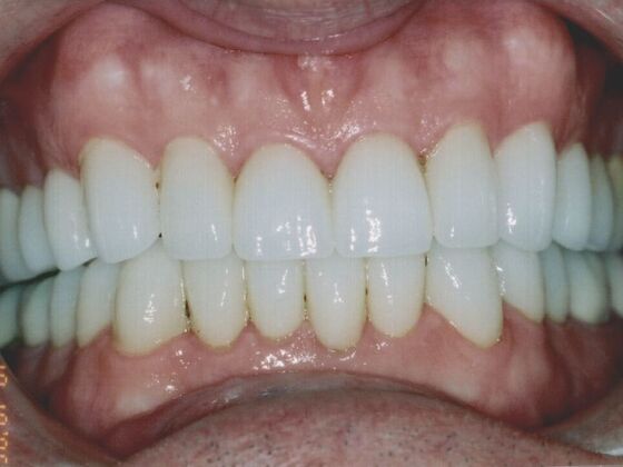 after veneers