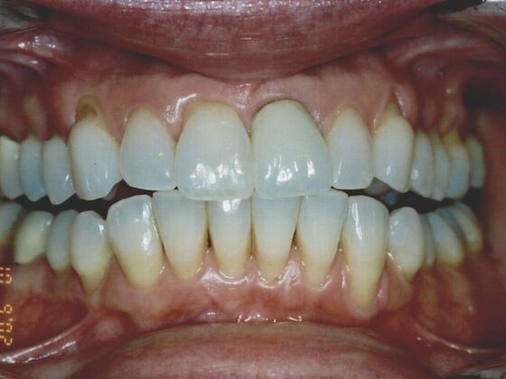 BEFORE VENEERS