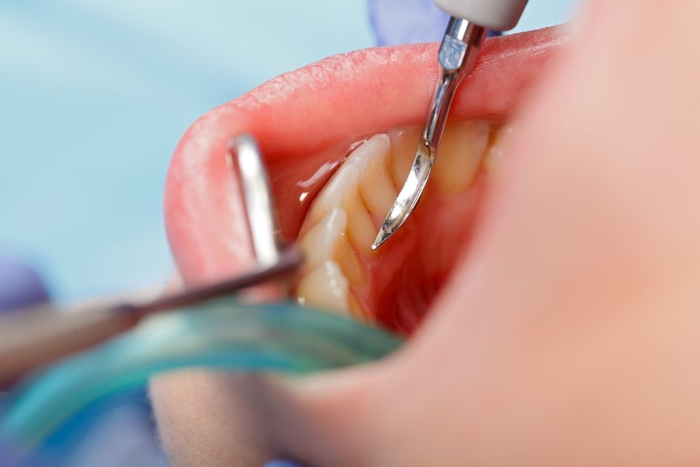 scaling and root planing, gum disease, prevention