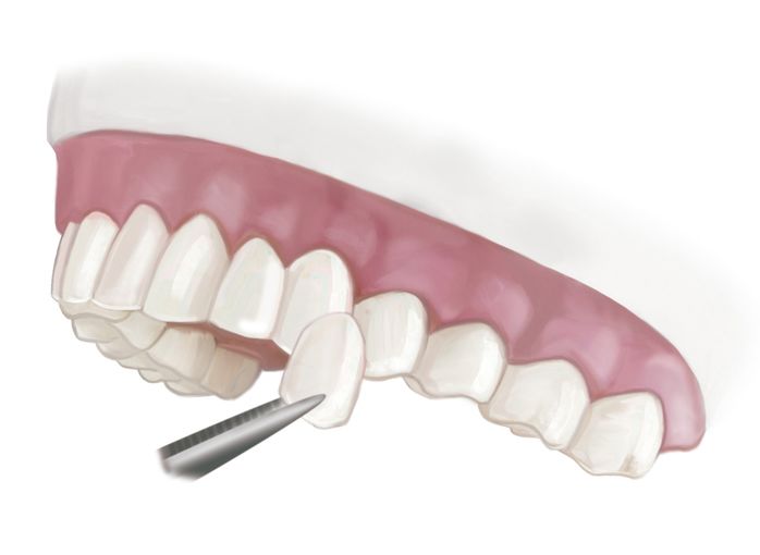 Illustration of a single veneer in front of a row of teeth