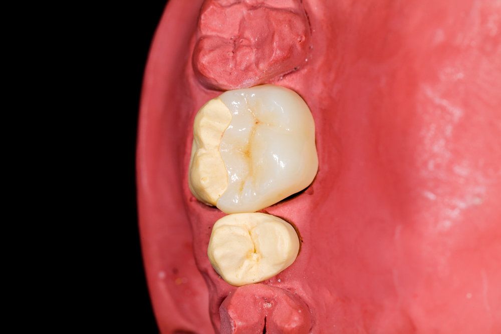 A ceramic onlay inside of a dental mold
