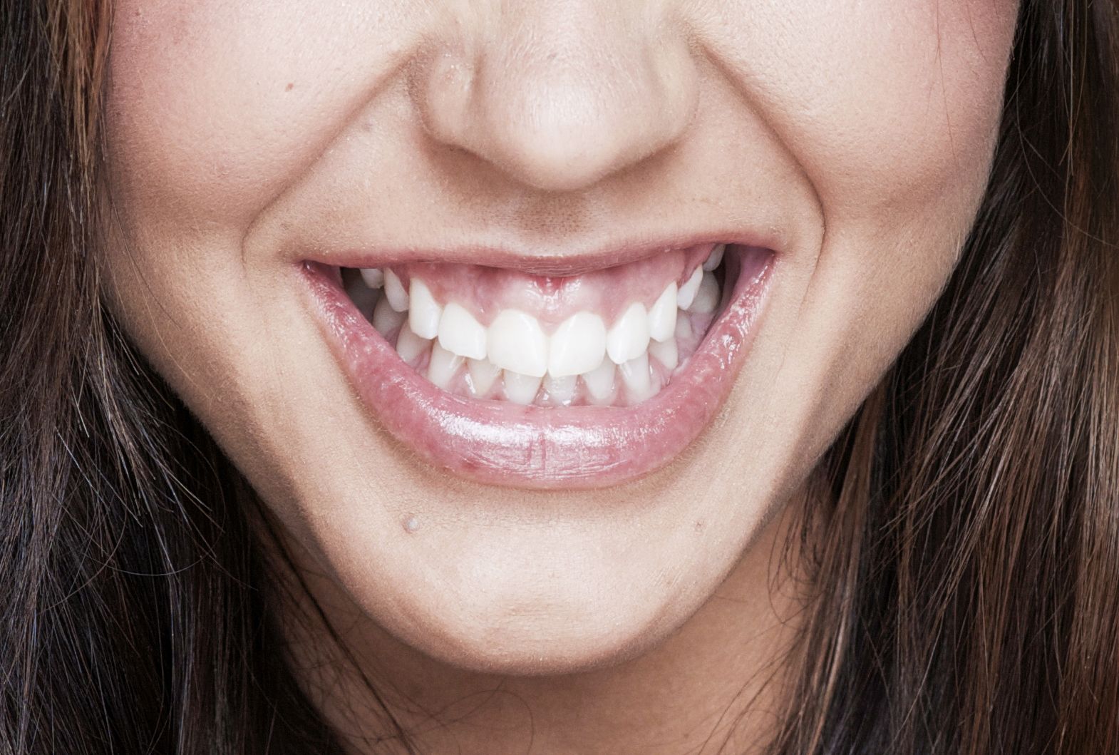 Photo of woman with gummy smile